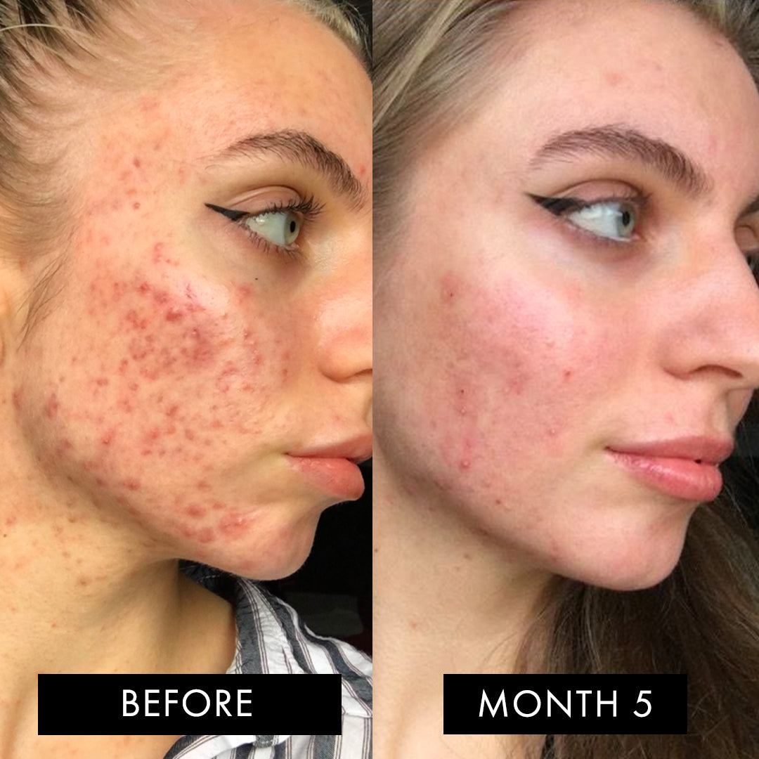 The Skin Elixir® Three Month Pack